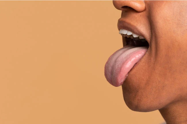 ลิ้นเป็นฝ้าขาว