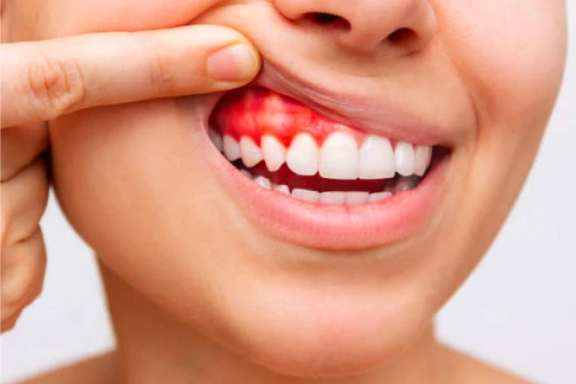 เหงือกอักเสบ